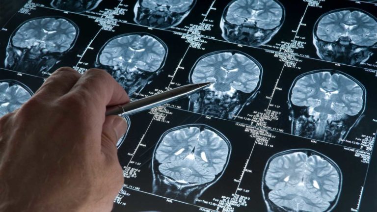 Prueban con éxito en ratones células madre para atacar el glioblastoma