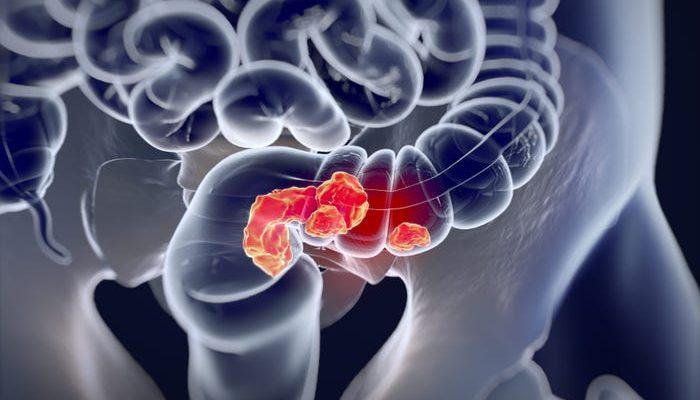 Un fármaco elimina el cáncer rectal en los 12 pacientes de un ensayo clínico